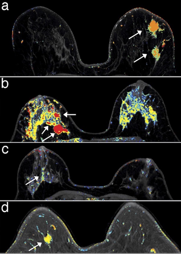 MRI扫描出的恶性（a，b）和良性（c，d）乳房病变由白色箭头指示。施用造影剂后最快“点亮”的区域是恶性肿瘤。